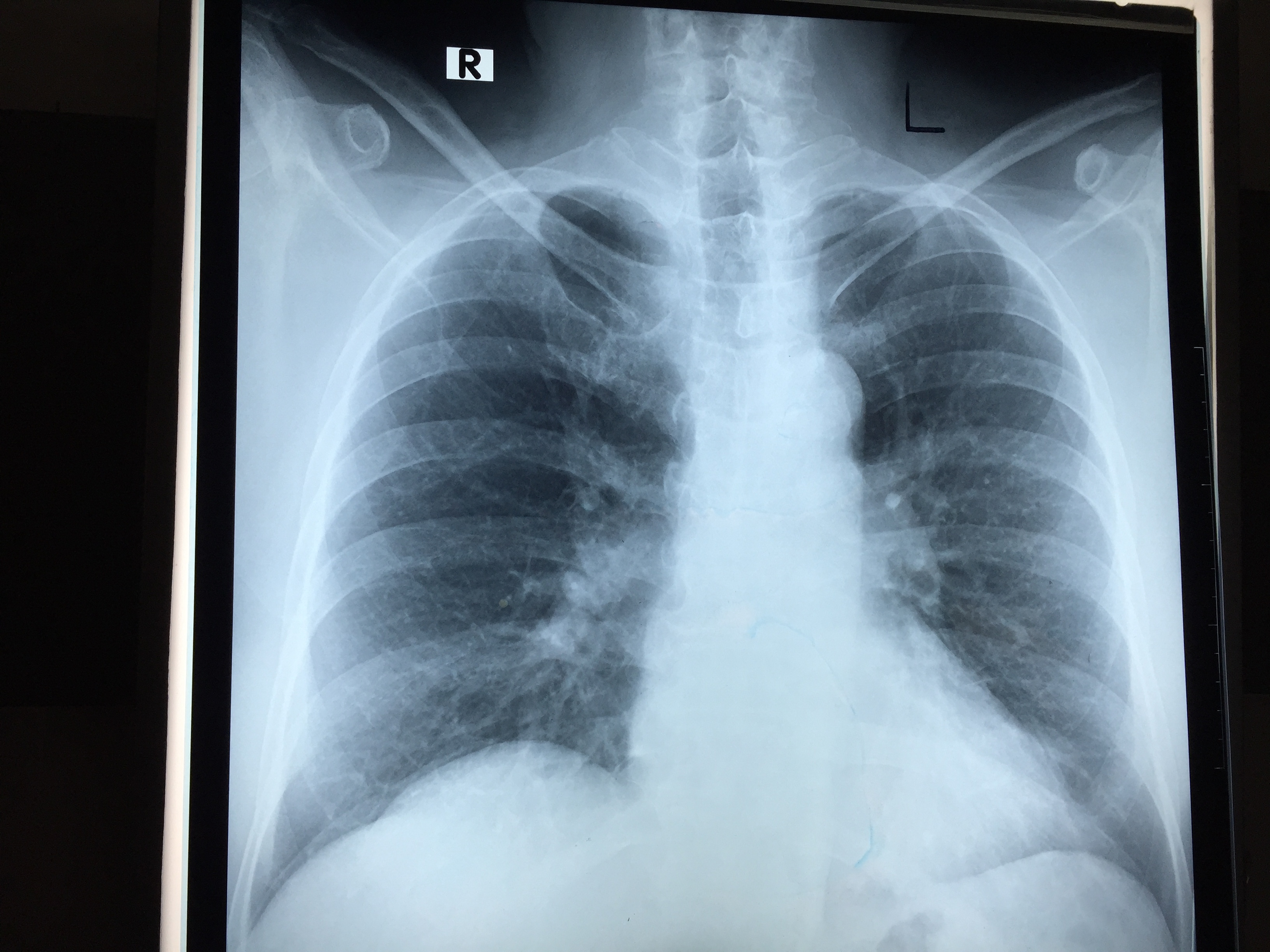 Air Under The Right Hemidiaphragm